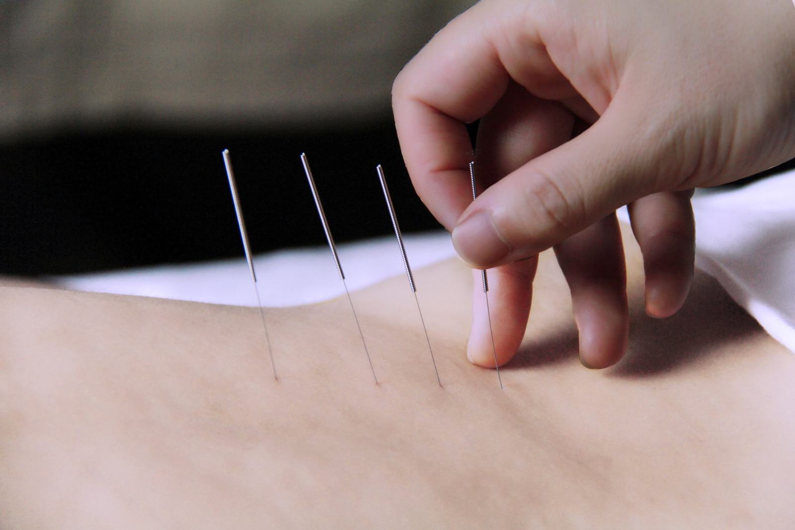 Acupuncture & external therapies
